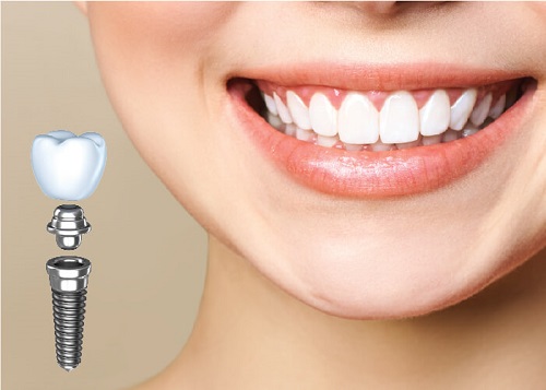 Trồng răng khểnh có đau không? Phương pháp phù hợp 1