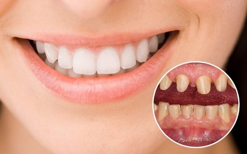 Có nên bọc răng sứ titan không? Tham khảo 2