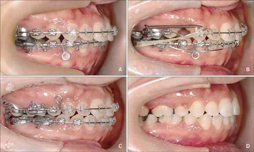Niềng răng lúc nào đau nhất? Các giai đoạn niềng răng 2