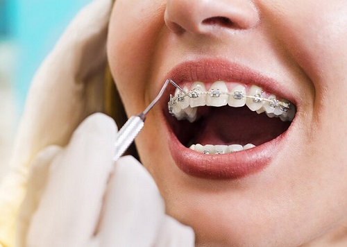 Niềng răng lúc nào đau nhất? Các giai đoạn niềng răng 3
