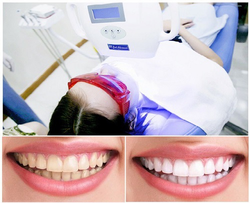 Sản phẩm làm trắng răng an toàn hiệu quả 3