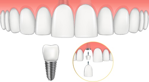 Kinh nghiệm làm răng implant cho người bị mất răng 1