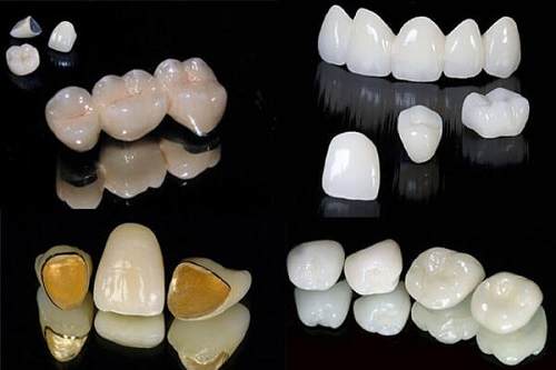 Kinh nghiệm làm răng implant cho người bị mất răng 3