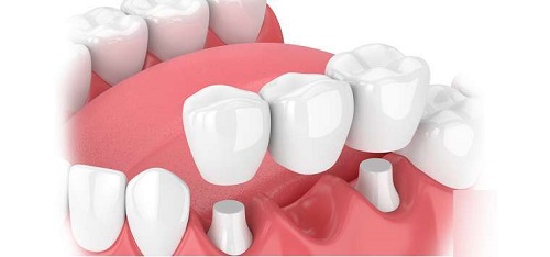 Bọc răng sứ khi mất răng và những điều cần biết 1