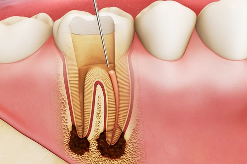 Trồng răng sứ có phải lấy tủy không? 1 Trồng răng sứ có phải lấy tủy không? 1