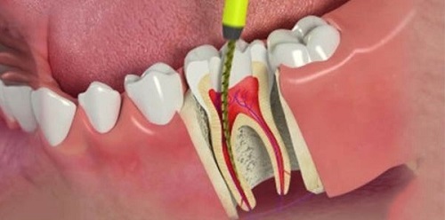 Trồng răng sứ có phải lấy tủy không? 2 Trồng răng sứ có phải lấy tủy không? 2