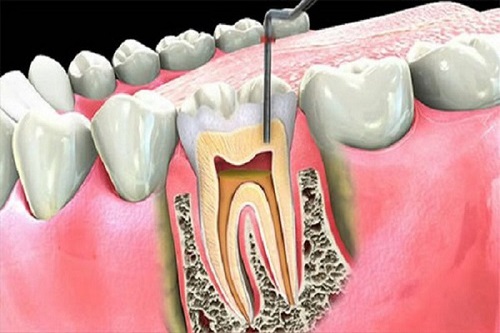 Trồng răng sứ có phải lấy tủy không? 3