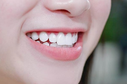 Trồng răng tại Cần Thơ hiệu quả an toàn 2