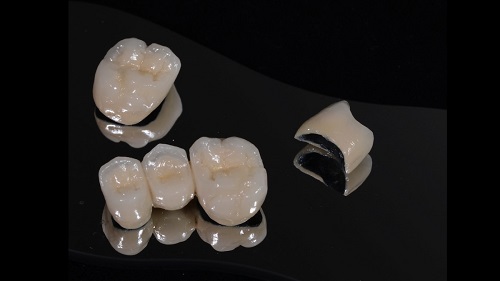 Răng sứ titan có bị đen không? Tìm hiểu về răng sứ 1