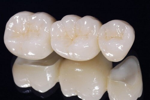 Răng sứ titan có bị đen không? Tìm hiểu về răng sứ 3
